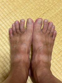 まだらの日焼け　モンベルのキャニオンサンダルを愛用している代償